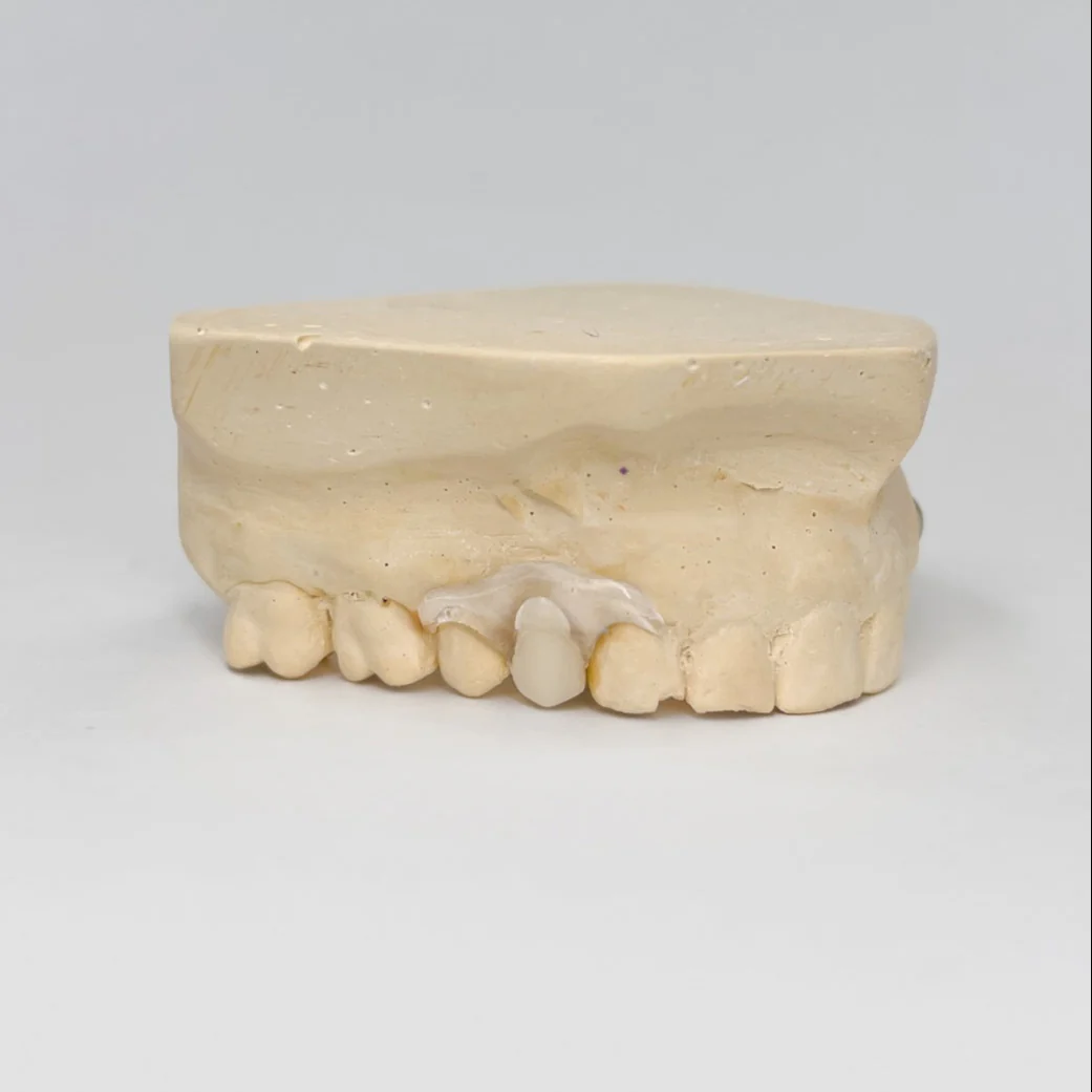 Clear Unilateral Partial Denture - Image 5