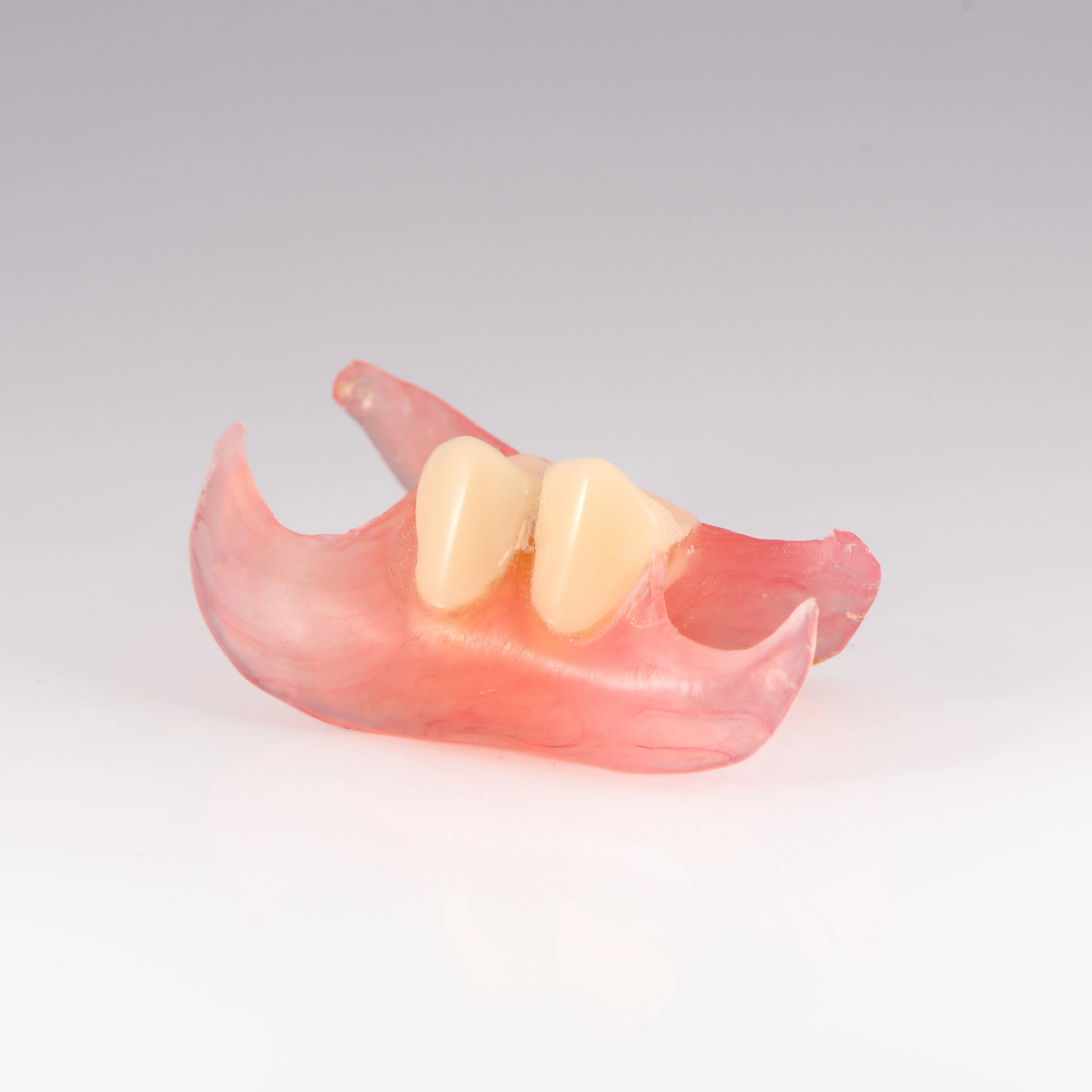 Unilateral Partial Denture - Image 3